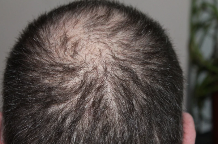 Male pattern baldness
